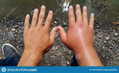 Swollen Hand Allergy To Bee Stings Two Hands Of A Person Stock Image