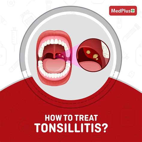 Medplus India On Linkedin How To Treat Tonsillitis