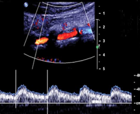 Color Doppler Imaging Evaluation Of Proximal Vertebral Artery Stenosis