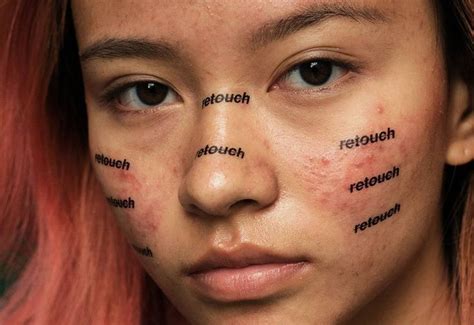 This Photographer Makes Acne Look Beautiful Cause Guess What Its Normal Acne Treatment