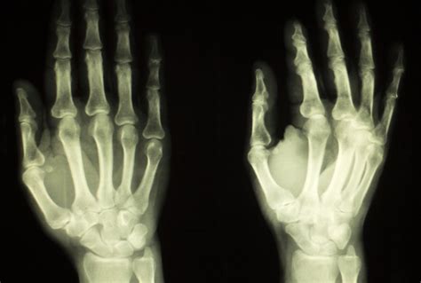 What To Do When You Have Swollen Finger Joints Livestrongcom