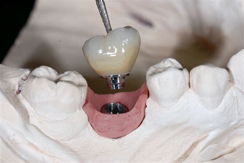 Screw Retained Dental Implant Crown And Bridge For Dental Lab