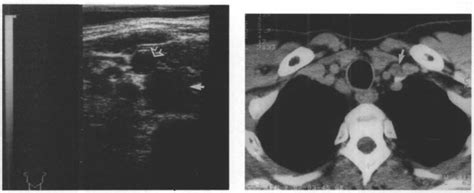 Axial Sonogram Of The Right Supraclavicular Fossa In A Patient With