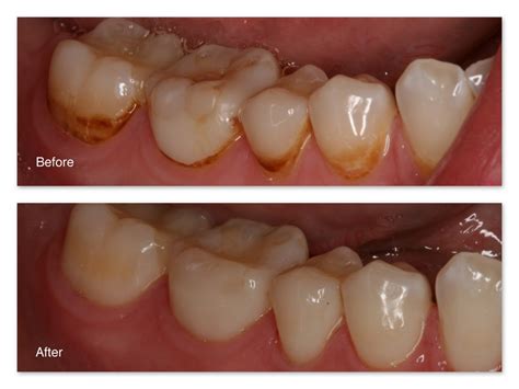 Removal Of Superficial Tooth Stains Gallery Dr Jack M Hosner Dds