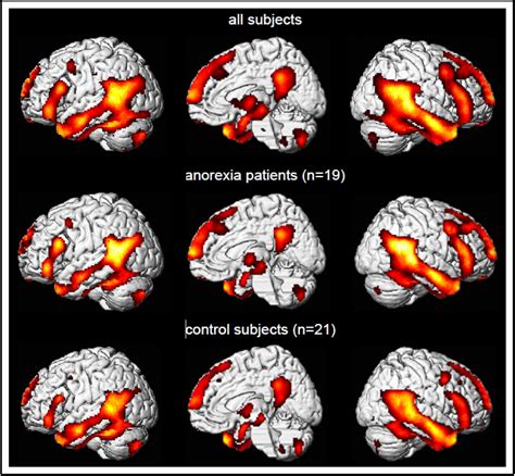 Theory Of Mind And The Brain In Anorexia Nervosa Relation To Treatment