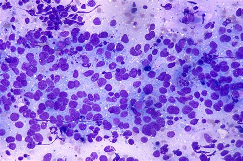 If the symptoms are persistent, an evaluation to determine their cause, including possible lymphoma, should be undertaken. High-grade lymphoma. Causes, symptoms, treatment High ...