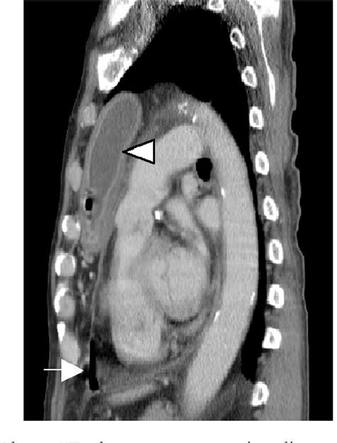 Figure 3 From Retrosternal Gastric Tube Ulcer Complicated By