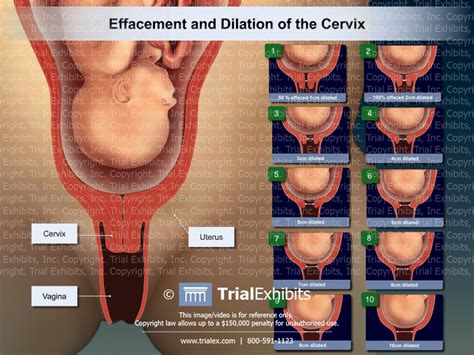 Effacement And Dilation Of The Cervix Trial Exhibits Inc