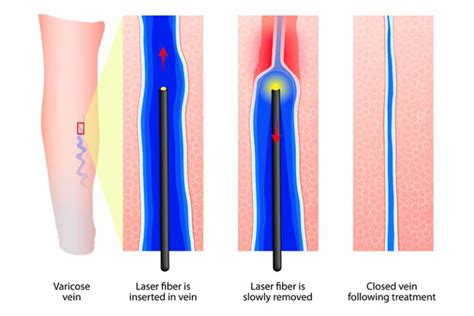 Varicose Veins And Treatment Of Venous Disorders Cora