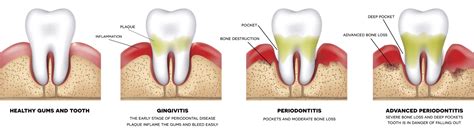 Gum Disease Treatment In Virginia Beach Va