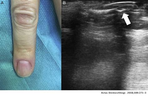 Ultrasound Guided Minimally Invasive Resection Of A Digital Glomus