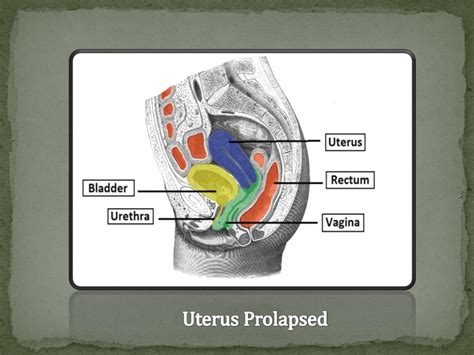 Diagram Of Prolapsed Uterus