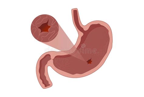 Cross Section Human Stomach Peptic Ulcer Human Heath Care Vector Stock