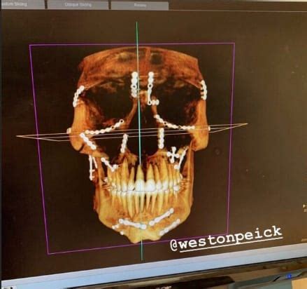 Yes, you read that correctly. New Weston Peick X-ray images in latest injury update ...