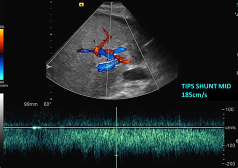 Transjugular Intrahepatic Portosystemic Shunting