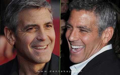 Shocking Celebrity Veneers With Before After Pictures