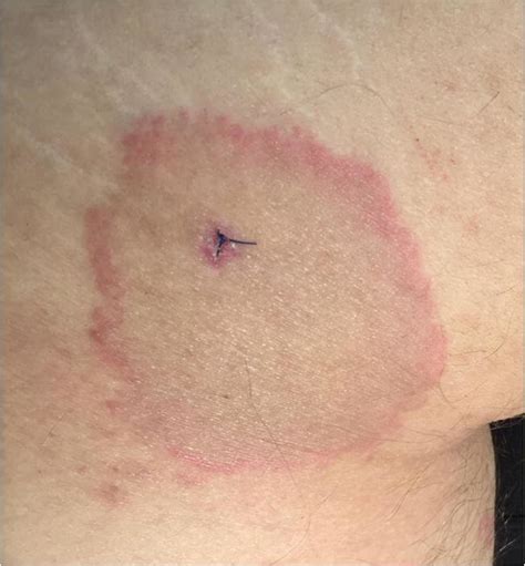 Erythema Migrans With Erythematous Border And Central Clearing