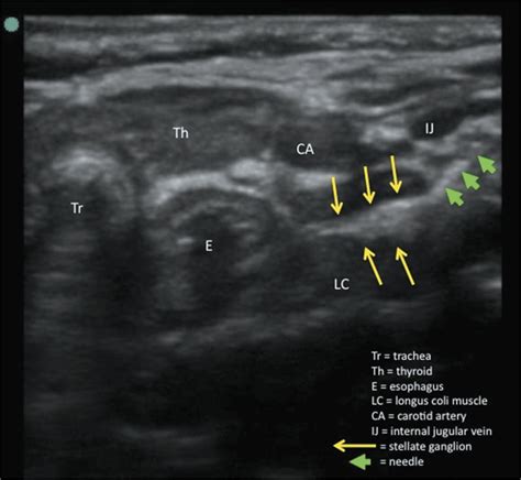 Percutaneous Ultrasound Guided Stellate Ganglion Nerve Block