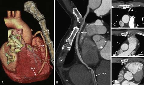 Coronary Artery Bypass Grafts Radiology Key