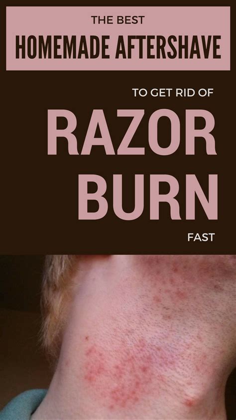 The Best Homemade Aftershave To Get Rid Of Razor Burn Fast Razor