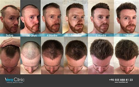 How Fast Does Hair Grow After Hair Transplant With Pictures Vera Clinic