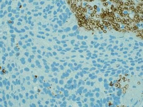 Biphasic sss differed from mesotheliomas by their more common berep4 positivity (90%) whereas ems showed focal reactivity. Mesothelial Hyperplasia - Thoracic Pathology: A Volume in ...