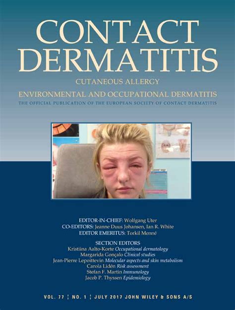 Allergic Contact Dermatitis Caused By Arbutin And Dipotassium