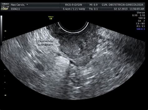 Squamous cell carcinoma), or lymphoma will seldom show a hilar line, thought to be due to interruption of lymphatic flow by tumor invasion. Figure 5 from The Role of Ultrasound in the Assessment of ...