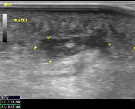 Abscess In Foot Image