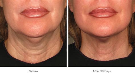 Before And After Gallery Non Surgical Ultrasound Lift Merz Ultherapy