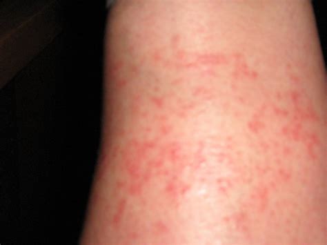 Hiv Rash On Forearm One Of Hiv Symptoms Is Rash Majestic Glow