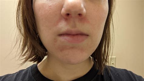 Allergic Reaction Skin Concern Rskincareaddiction