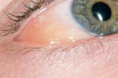 Allergic Conjunctivitis And Oedema Photograph By Dr P Marazziscience