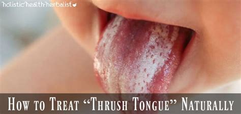 How To Treat “thrush Tongue” Naturally Holistic Health Herbalist