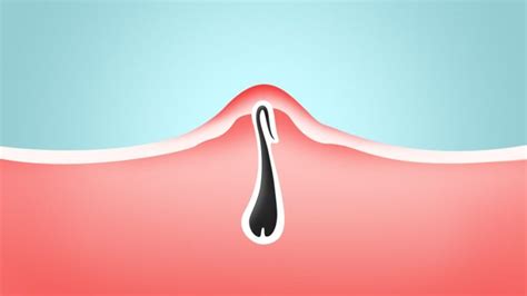 All You Need To Know About Ingrown Hairs The Laser Beautique
