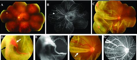 First Fundus Photograph And Fluorescence Angiography Fa Of The