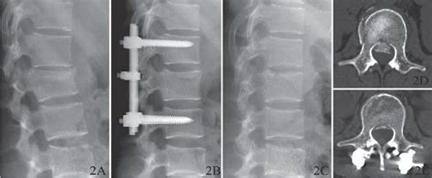 Figure 2 From Treatment Of Thoracolumbar Burst Fractures Short Segment