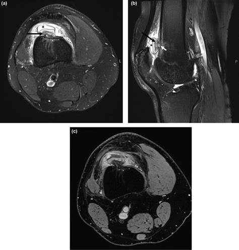 Mri Axial A And Sagittal B T2 Fat Suppressed Sequences Demonstrate