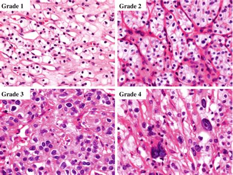 The Who Classification Of Renal Tumors Pathology Outlines A Valuable