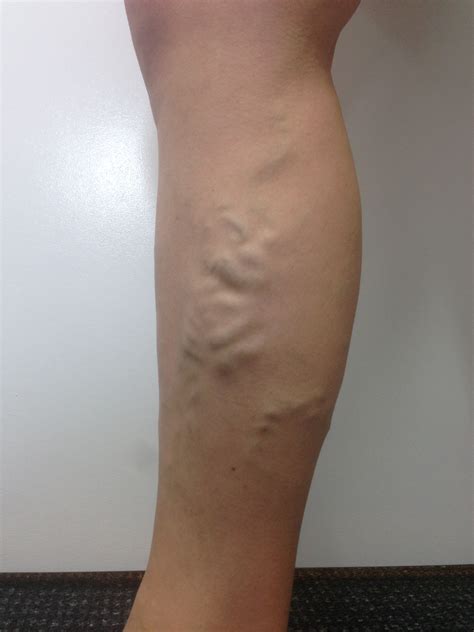 Varicose Vein Results And Post Treatment Photos The Leg Vein Doctor