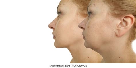 Woman Double Chin Before After Treatment Stock Photo 2147023233