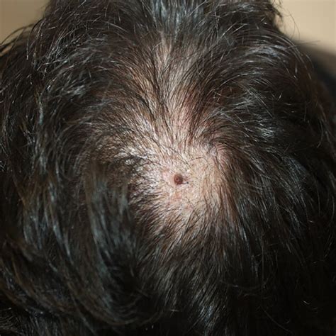 Alopecia Mucinosa Am A Multiple Plaques Of Am On The Scalp B C