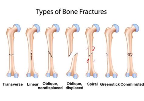 Fractures Flashcards Quizlet