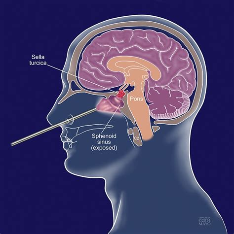 Advances In Endoscopic Pituitary Surgery For Medical Professionals