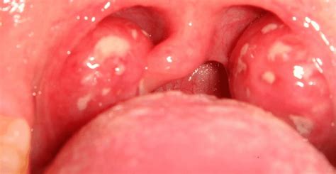 White Spots On Tonsils No Fever No Pain One Std Cancer Swollen