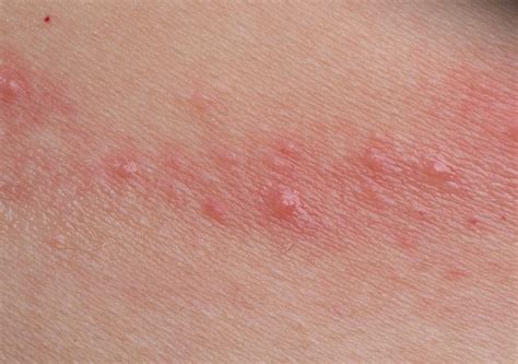Una Guida Alle Cause Comuni Di Dermatite Da Contatto