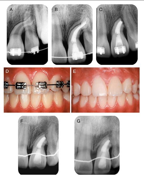 Figure 2 From Orthodontic Surgical Endodontic Management Of Unerupted