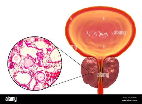 Light Micrograph Left And Computer Illustration Right Showing Benign Prostatic Hyperplasia