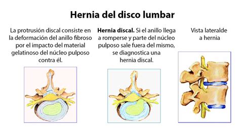 Síntomas Y Diagnóstico De La Hernia Del Disco Lumbar