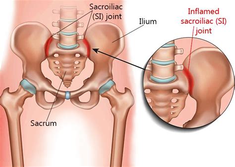 Sacroiliac Joint Pain Specialists In NYC New York Pain Care